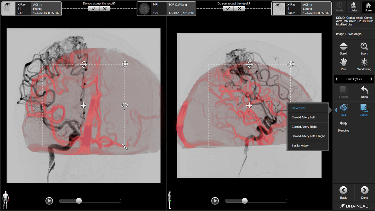 Software Solution for Cranial Vascular Planning | Brainlab